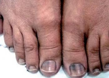 Продольные полосы на ногтях: причины и методы лечения Коричневые полоски на ногтях как заноза