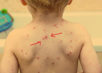 При каких заболеваниях появляются красные пятна на коже?